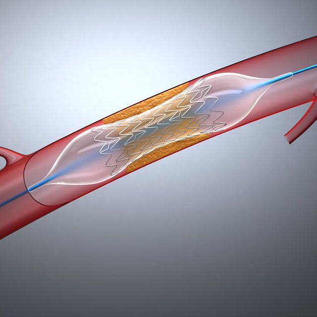 Сердечные стенты (Stent)