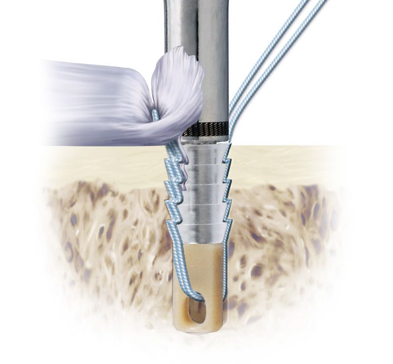  Якорь Bio-Force Soft в хирургических сценариях